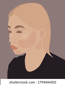 Acne positive. Girl character with acne. Woman with skin problems. Teenage girl. Girl with acne on the face. Acne on the face.