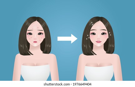 Acne problem. Pretty woman's face before and after concept. 