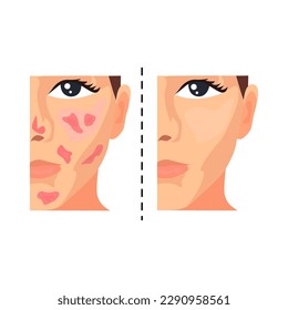 Acne removal illustration in color cartoon style. Editable vector graphic design.