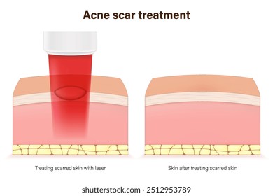 Acne scar and laser treatment. Skin repair. Steps of during and after laser scar treatment.