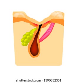 Acne scar. The structure of the skin. Wrinkles. Infographics. Vector illustration on isolated background.