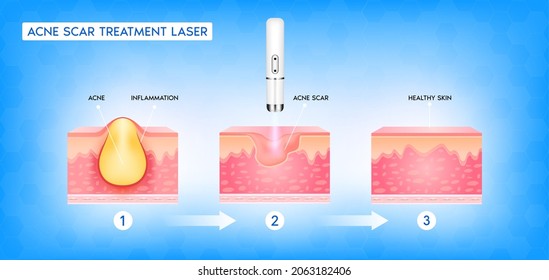 Acne scar vascular laser treatment. Inflammation associated with pimples. The structure of the skin acne scar. Medical beauty skin care concept. 3D vector illustration.