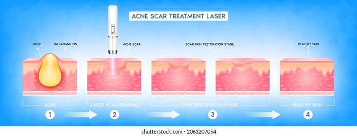 Acne scar vascular laser treatment. Inflammation associated with pimples. The structure of the skin acne scar. Medical beauty skin care concept. 3D vector illustration.