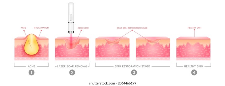 Acne scar vascular laser treatment inflammation associated with pimples. On a white background. The structure of the skin acne scar. Medical beauty skin care concept. 3D vector illustration.