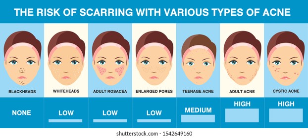 Acne scars. Different types of acne. Infographics. Skin problems. Skin health. Vector Illustration