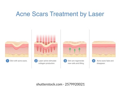 Acne scars treatment by laser. Laser active stimulate collagen, regenerate and lifting from under skin layer. Make acne scars and hole fade and disappear.