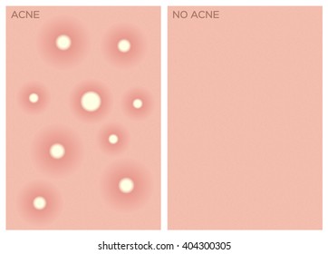 acne skin , before and after texture , vector