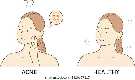 Acne skin with black dots. Face with pimples, acne. Teenager skin. The girl worries about unhealthy skin of her face. Skincare and dermatology. Face mask, cream. 