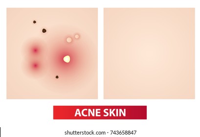 Acne skin to clear before and after vector illustration