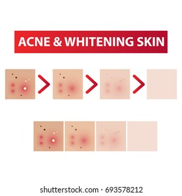 Acne Skin To Clear Steps And Whitening Tones Vector Illustration