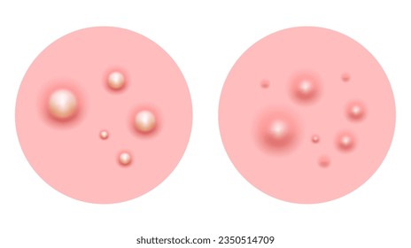 Acne skin pimple, vector illustration