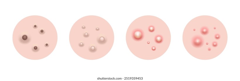 Espinha de pele de acne, ilustração vetorial