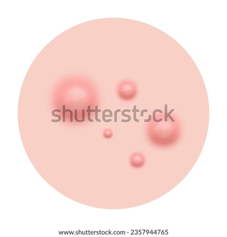 Acne skin pimple, vector illustration