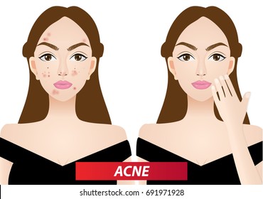 Acne Skin Problems Before After Vector Stock Vector (Royalty Free ...