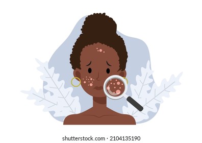 Acne skin problems Concept.African american woman with magnifying glass is looking acne on his facial. Falt vector cartoon illustration.
