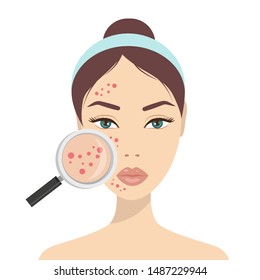Acne skin problems. Woman holding magnifying glass for looking cystic acne on her facial. Vector illustration about skin problem concept