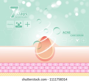 acne skin spot pimple problem vector design.