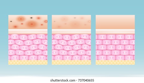 acne skin spot pimple problem vector design.