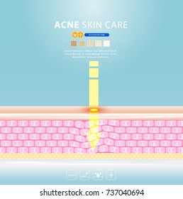 acne skin spot pimple problem vector design.