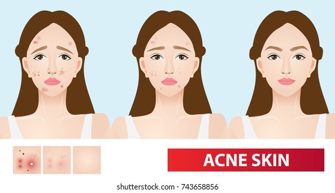 Acne Skin Of Woman To Clear Steps Vector Illustration