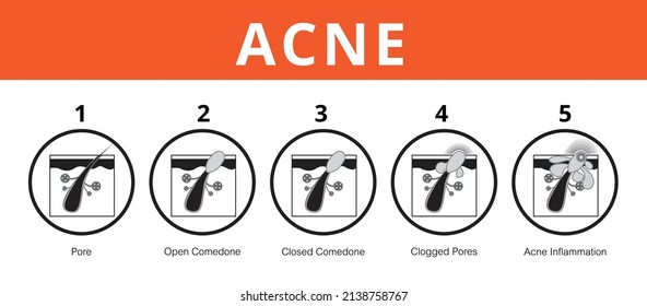 Acne, stages of development, healthy skin, vector design