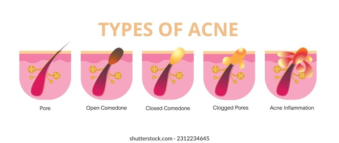 Acne, stages of development,healthy skin,vector design