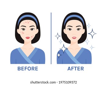 Acne Treatment Before After Asia Woman Stock Vector (Royalty Free ...