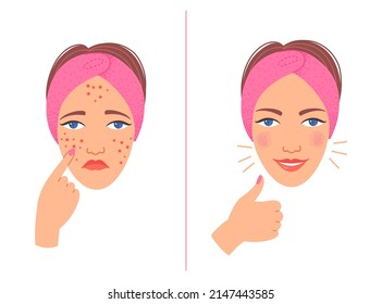 Acne Treatment Before After Cartoon Illustration Stock Vector (Royalty ...