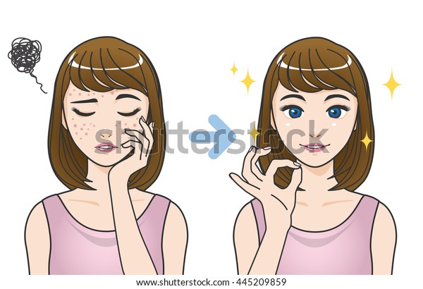 Acne Treatment Before After Cartoon Illustration Stock Vector Royalty Free 445209859