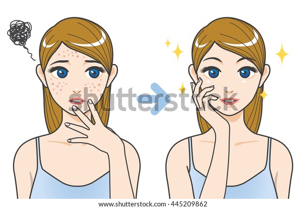 Acne Treatment Before After Cartoon Illustration Stock Vector Royalty Free 445209862