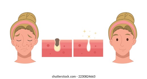 Acne treatment before after concept, facial cleansing foam, Vector cartoon illustration