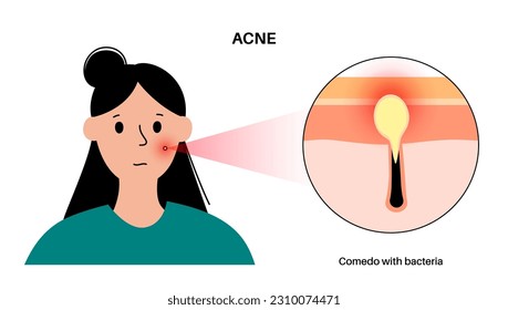 Aknebehandlung Tote Zellen und Öl aus den Haarfollikeln der Haut. Whiteheads und Pimples, Bakterien im Comedo. Diagramm der Hautschichten, Epidermis, Dermis und Hypodermis, Vektorgrafik.