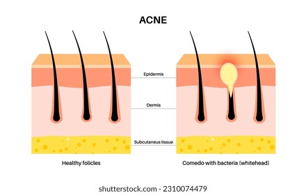 Acne treatment concept. Dead cells and oil from the skin clog hair follicles. Whiteheads and pimples, bacteria in comedo. Skin layers diagram, epidermis, dermis and hypodermis vector illustration.
