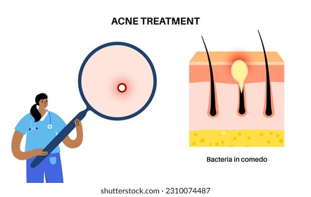 El concepto de tratamiento del acné. Células muertas y aceite de los folículos peliculares de la piel. Cabezas blancas y granos, bacterias en comedo. Diagrama de capas cutáneas, epidermis, dermis e hipodérmis vectoriales.