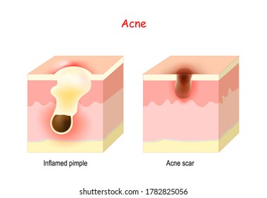 Acne Treatment Cross Section Human Skin Stock Vector (Royalty Free ...