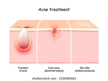 Akne Behandlung. Kreuzung der Haut von Akne zu Narben oder abnormaler Heilung. gesunde Haut, Haut vor und nach medizinischen Behandlungen