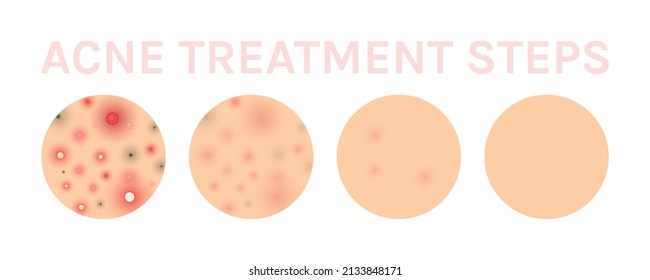 Akne Treatment Steps. Whitening of Human Skin. Gesichtsbilder auf der Problemhaut. Nahaufnahme der sauberen gesunden Haut. Farbrealistischer Stil. Weißer Hintergrund. Bild für Schönheit und medizinisches Design. Vektorgrafik