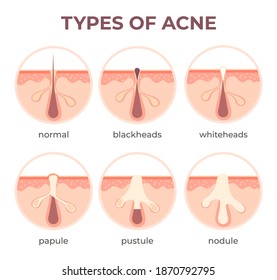 Acne Types Anatomy. Pimple Diseases Sectional View Blackhead, Cystic And Whitehead. Structure Of Skin And Pore Infection Vector Infographic. Open And Closed Comedones. Medical Disease