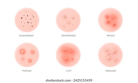 Tipos de acné, granos en la piel del cuerpo o de la cara y problemas de inflamación, iconos vectoriales. Tipos de acné, puntos negros, pústulas o puntos blancos, pápulas y quistes con nódulos para el cuidado de la piel cosmetología de belleza y dermatología