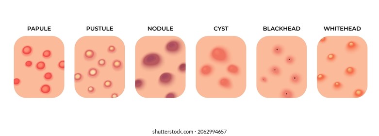 Acne Types. Facial Infections, Pimples And Skin Inflammation. Skincare, Face Acne Breakout. Dermatology Epidermis Disease Recent Vector Set