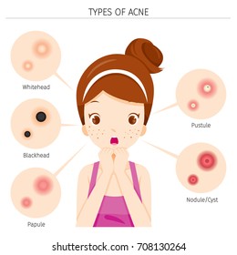 Acne Types And Girl With Acne On Face, Facial, Beauty, Cosmetic, Makeup, Treatment, Healthy