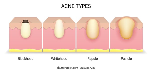 Acne types. Human skin acne. Blackhead, Whitehead, Papule and Pustule. Vector for advertising about beauty and medical treatment.