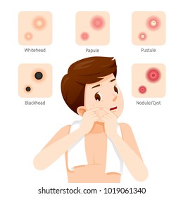 Acne Types And Man With Acne On Face, Facial, Skin, Treatment, Beauty, Cosmetic, Makeup, Healthy, Lifestyle