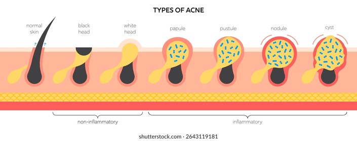 Acne types medical vector infographic. Acne vulgaris in skin structure: whitehead and blackhead, papule and pustule, nodule and cyst. Dermatology diagram for skincare and treatment education.