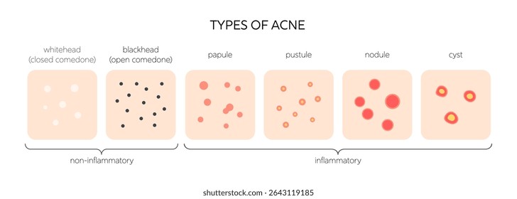 Infográfico de vetor médico de tipos de acne. Acne vulgar à superfície da pele: cabeça branca e cabeça preta, pápula e pústula, nódulo e cisto. Diagrama dermatológico para cuidados da pele e educação de tratamento.