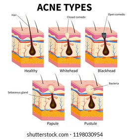 Acne types. Pimple skin diseases anatomy medical vector diagram. Illustration of follicle and pimple, medicine anatomy, papule and pustule