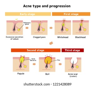 Acne types and progression illustration