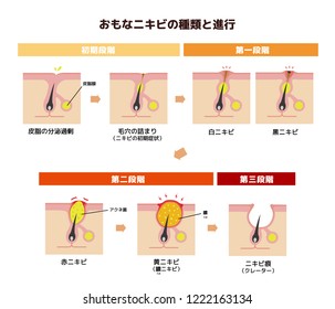 Acne types and progression illustration ( Japanese) : translation / Excessive secretion
of sebum,Clogged pore,Whitehead,Blackhead,Papule,Boil,Acne scar etc.