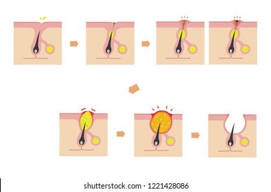 Acne types and progression illustration (No text)