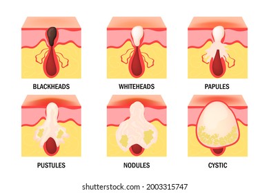 Tipos de acné establecidos. Enfermedad cutánea, dermatología, concepto cosmetológico. Infografías médicas. Afiche científico. Pancarta panorámica con información útil. Ilustración vectorial aislada en fondo blanco. 